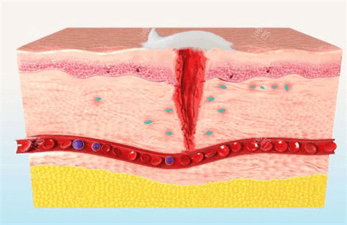 生长因子可以促进皮肤疤痕修复