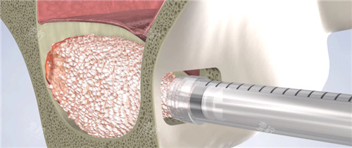 种植牙加骨粉骨膜过程什么样?会不会很痛