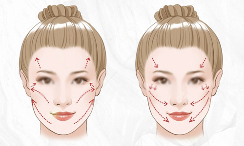 眼袋切口中面部提升的术式方法科普,和传统拉皮有什么区别